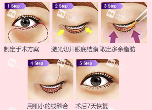 去眼袋手術過程