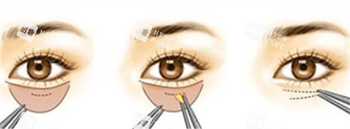 內(nèi)切法祛眼袋的手術步驟