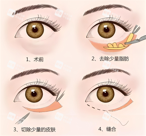 外切祛眼袋術(shù)原理 外切祛眼袋術(shù)原理