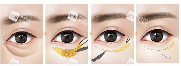 外切祛眼袋 外切祛眼袋