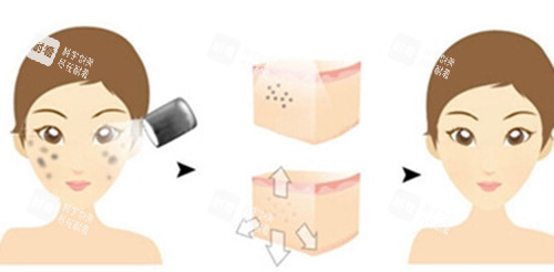 面部激光祛斑前后對(duì)比卡通示意圖 面部激光祛斑前后對(duì)比卡通示意圖