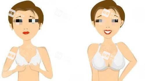 假體隆胸術(shù)后示意圖