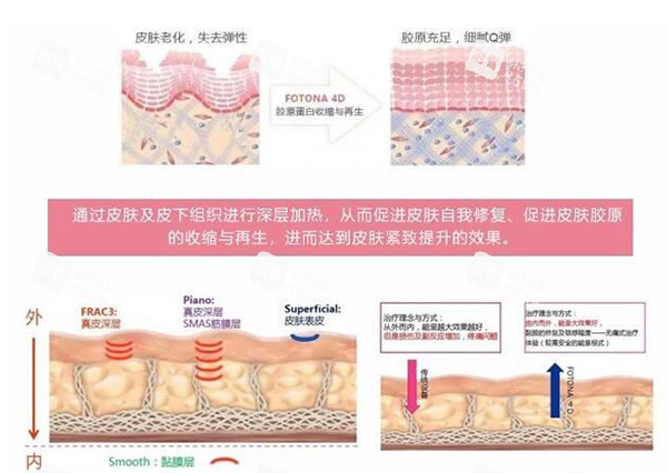 歐洲之星fotona4dpro改善皮膚示意圖