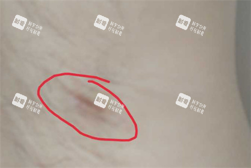 腋臭區(qū)域圖