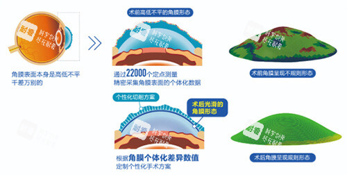 近視眼手術(shù)前后角膜變化示意圖 近視眼手術(shù)前后角膜變化示意圖