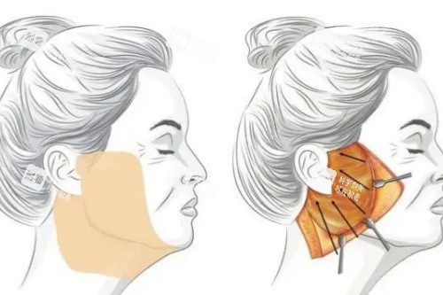 筋膜懸吊提升術(shù)卡通圖