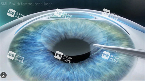 全飛秒手術(shù)演示圖 全飛秒手術(shù)演示圖