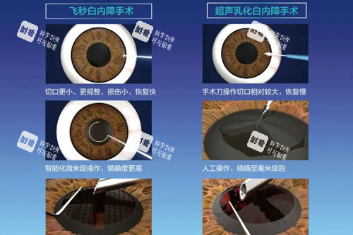 飛秒白內(nèi)障和超聲乳化白內(nèi)障 飛秒白內(nèi)障和超聲乳化白內(nèi)障