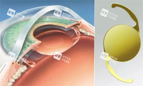 白內(nèi)障人工晶體的選擇 白內(nèi)障人工晶體的選擇