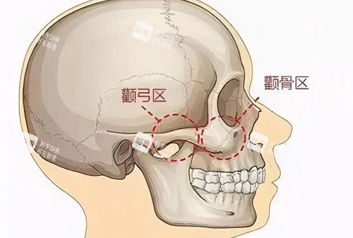 顴弓顴骨位置示意圖 顴弓顴骨位置示意圖