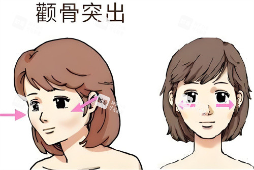 顴骨突出動畫演示圖 顴骨突出動畫演示圖