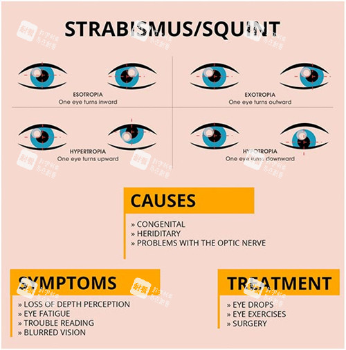斜視手術(shù)介紹圖