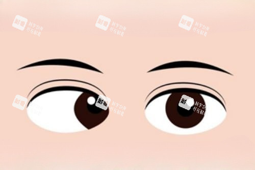 眼睛斜視卡通圖