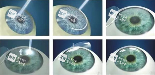 全飛秒近視手術(shù)過程詳細圖解