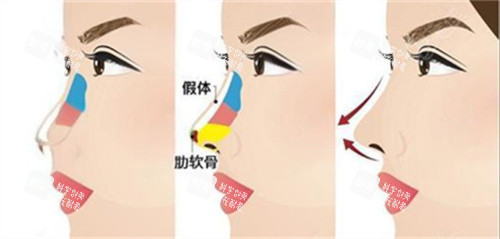 鼻綜合術(shù)后對(duì)比 鼻綜合術(shù)后對(duì)比