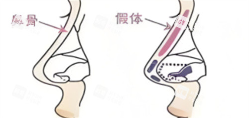 鼻綜合假體植入 鼻綜合假體植入
