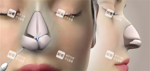 鼻綜合鼻骨動(dòng)畫(huà) 鼻綜合鼻骨動(dòng)畫(huà)