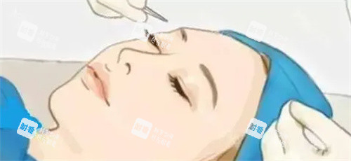 雙眼皮手術(shù)過程卡通圖