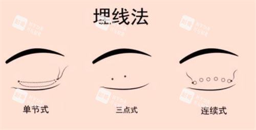 埋線雙眼皮經(jīng)過(guò)