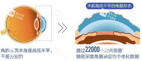 個性化飛秒術(shù)前 個性化飛秒術(shù)前