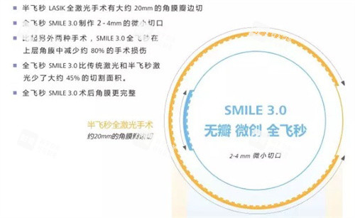 全飛秒手術(shù)3.0 全飛秒手術(shù)3.0
