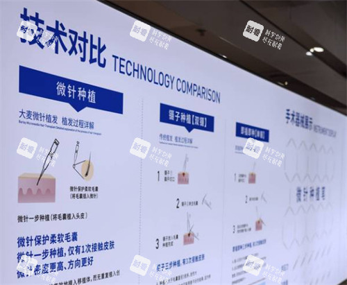 溫州大麥植發(fā)技術(shù)簡(jiǎn)介 溫州大麥植發(fā)技術(shù)簡(jiǎn)介