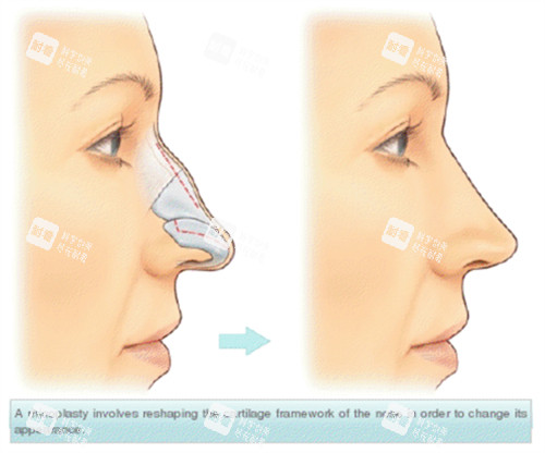 假體隆鼻