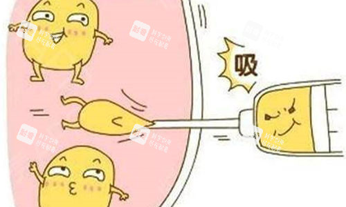 吸脂手術(shù)示意圖 吸脂手術(shù)示意圖