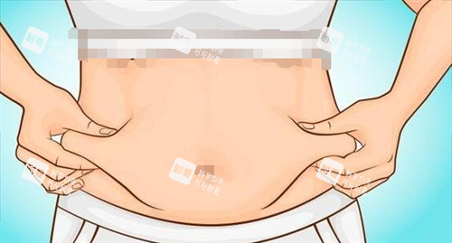 吸脂手術(shù)腹部脂肪堆積 吸脂手術(shù)腹部脂肪堆積