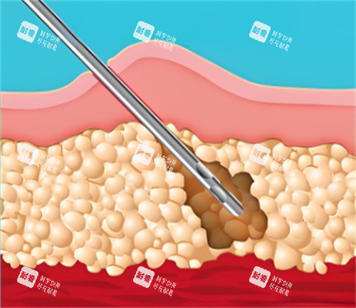 吸脂手術(shù)皮膚層 吸脂手術(shù)皮膚層