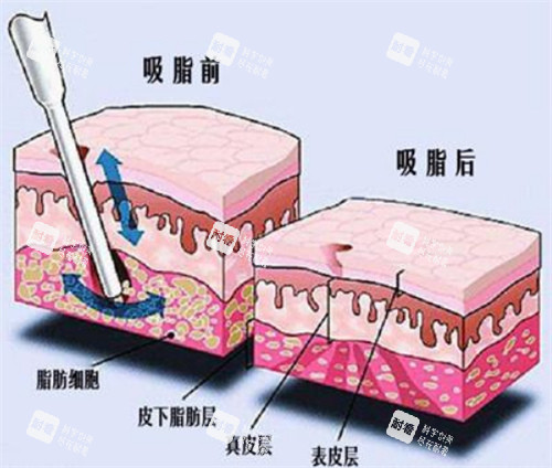 吸脂手術(shù)前后對(duì)比動(dòng)畫(huà)圖示 吸脂手術(shù)前后對(duì)比動(dòng)畫(huà)圖示