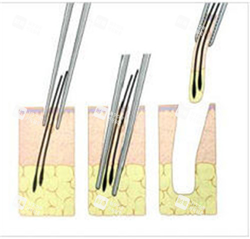 提取毛囊動(dòng)畫(huà)圖