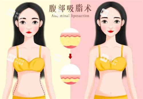 宋建星醫(yī)生吸脂怎么預(yù)約？線上+線下全攻略+2025吸脂全新價格表