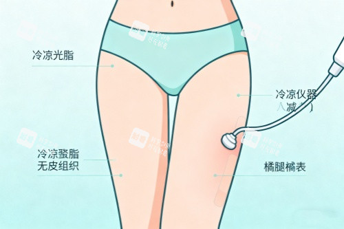 腿部做吸脂卡通圖一覽 腿部做吸脂卡通圖一覽