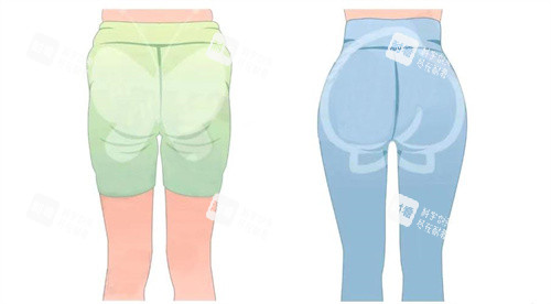 臀部吸脂手術(shù)背面對比動(dòng)畫圖 臀部吸脂手術(shù)背面對比動(dòng)畫圖