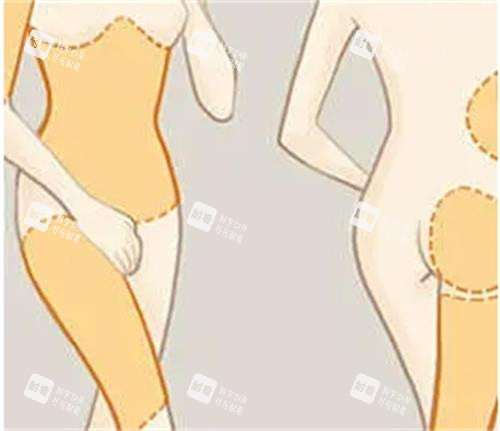 吸脂手術(shù)前后對比圖 吸脂手術(shù)前后對比圖