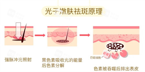 光子嫩膚的祛斑原理