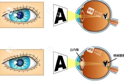 白內(nèi)障和正常眼睛卡通對(duì)比一覽圖 白內(nèi)障和正常眼睛卡通對(duì)比一覽圖