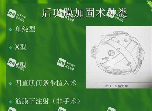 后鞏膜加固術(shù)種類