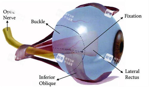 后鞏膜加固術(shù)動畫圖