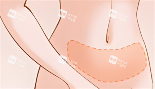 吸脂腹部區(qū)域