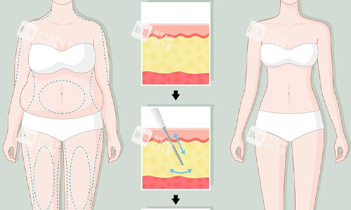 全身吸脂展示圖
