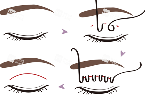 埋線雙眼皮手術(shù)步驟圖