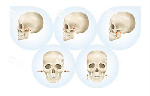 磨骨手術手術過程 磨骨手術手術過程