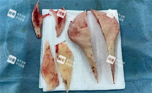 磨骨手術切掉的骨頭 磨骨手術切掉的骨頭