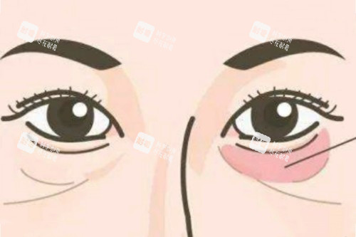 成都軍區(qū)整形醫(yī)院眼袋手術(shù)貴嗎？含詳細(xì)報(bào)價(jià)、術(shù)式對(duì)比及術(shù)后服務(wù)說(shuō)明