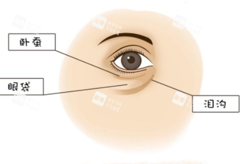 臥蠶、眼袋、淚溝展示圖