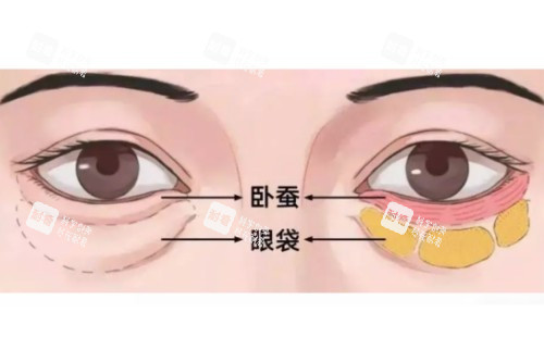 眼袋、臥蠶區(qū)分圖