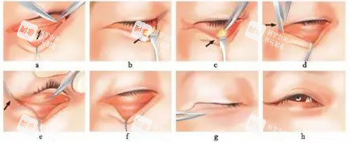 去眼袋手術(shù)方法