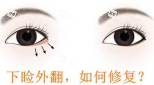 下眼瞼外翻怎么辦